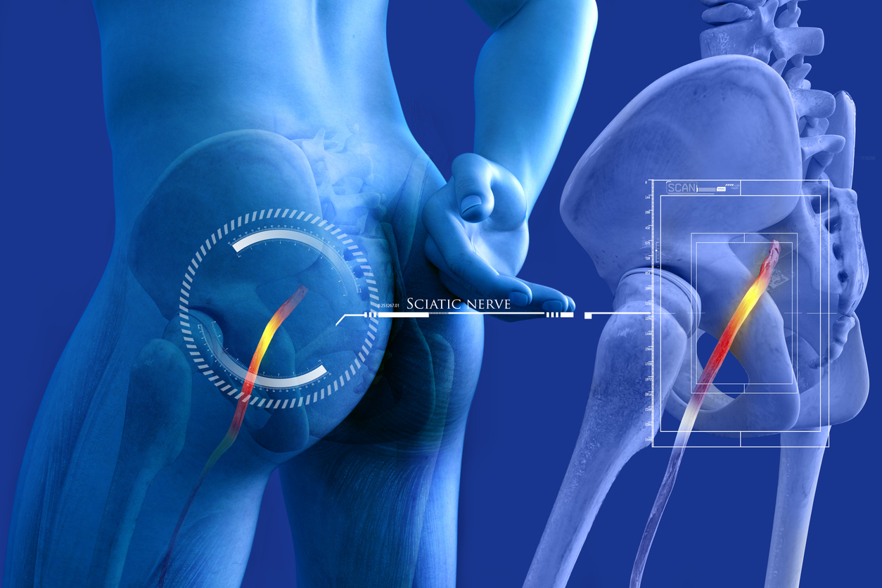 sciatic nerve irritation